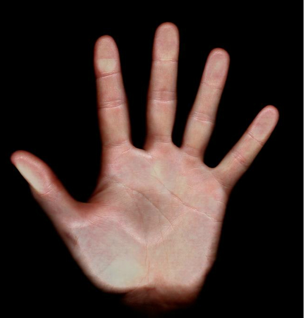 Latvijas mikroķirurgu aprūpē nonācis bērns ar septiņiem rokas pirkstiem