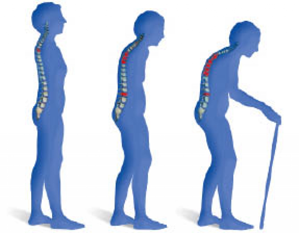 20. oktobris - Pasaules Osteoporozes diena